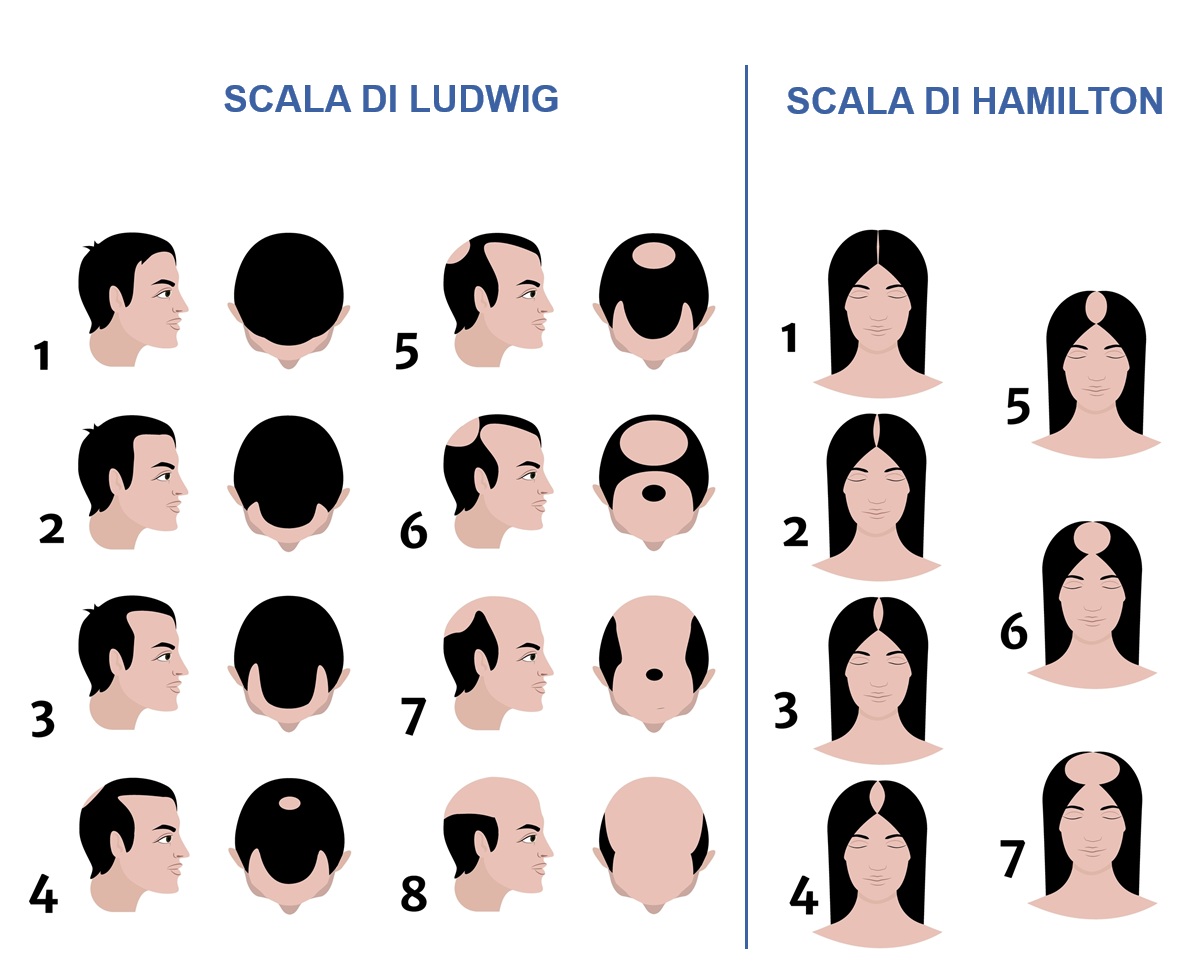 Classificazione della caduta dei capelli