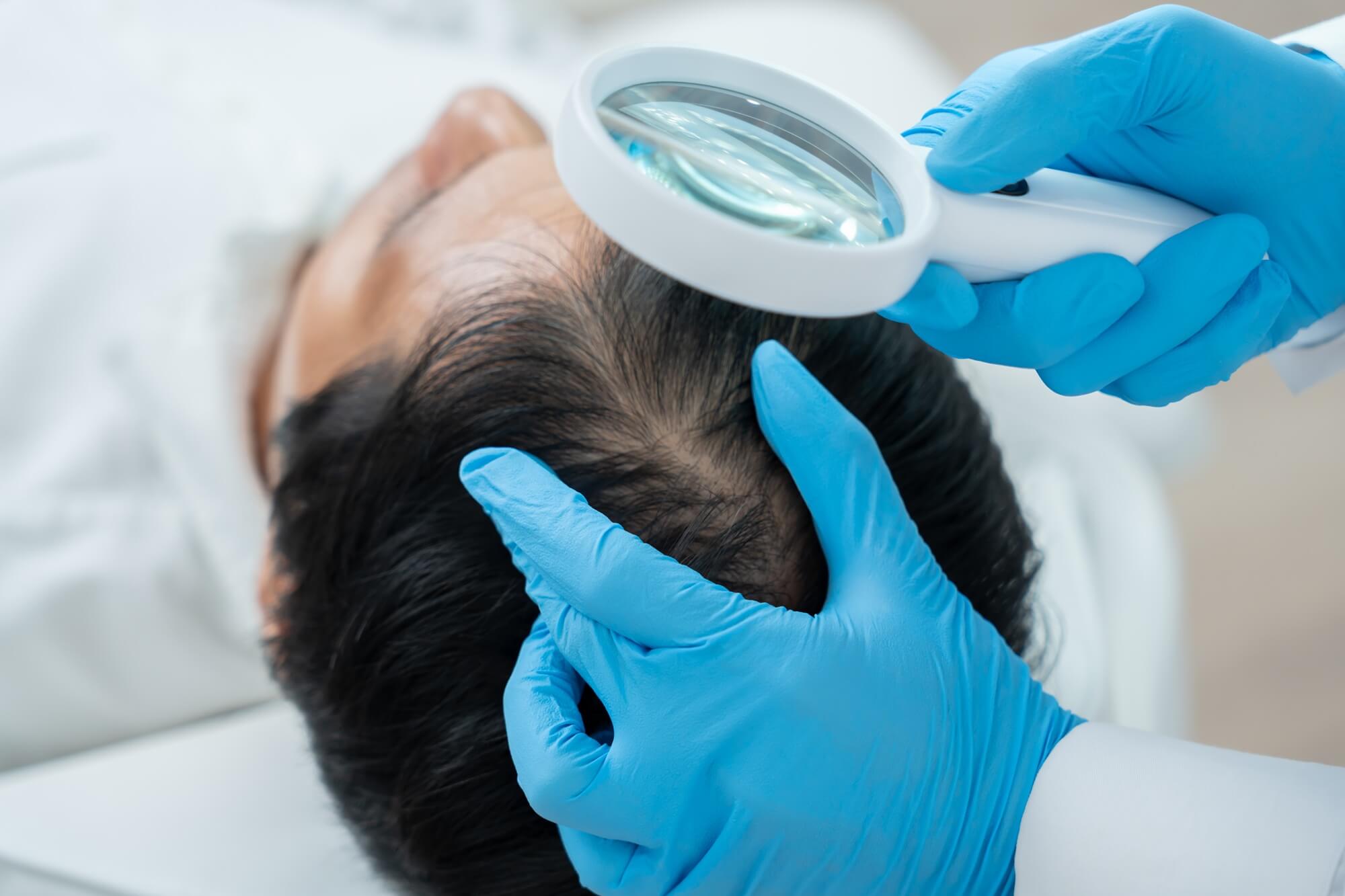 fotobiomodulazione capelli Reggio Emilia
