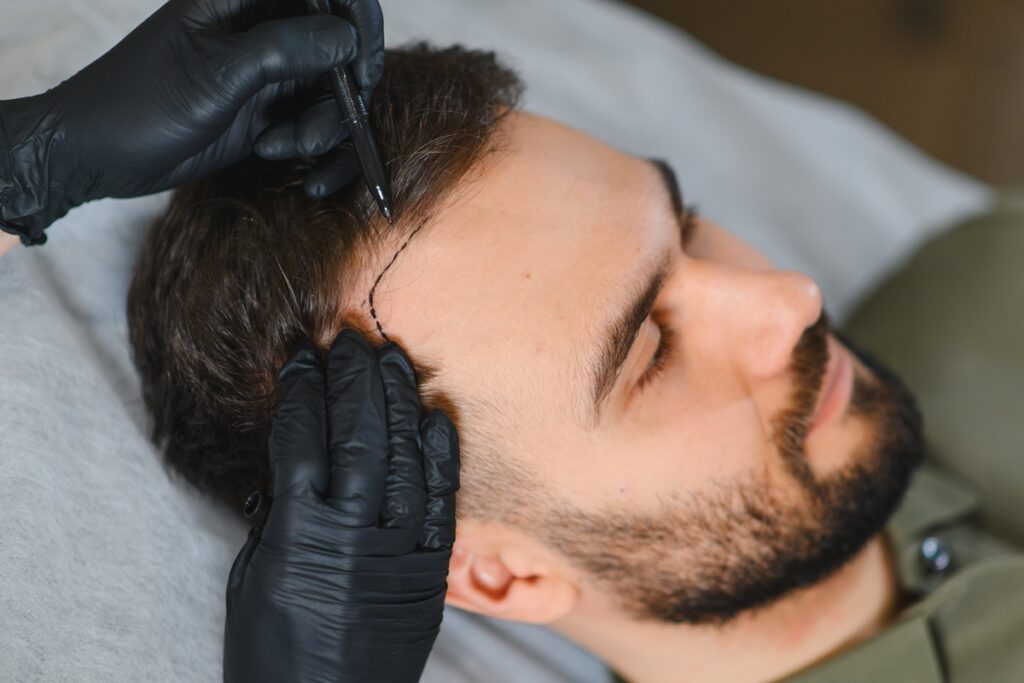 autotrapianto capelli Reggio Emilia